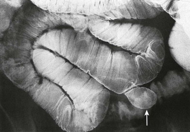 Applied Embryology Of The Gastrointestinal Tract | Radiology Key