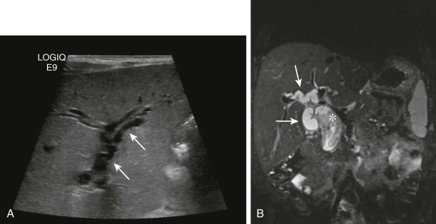 Diseases Of The Pediatric Gallbladder And Biliary Tract | Radiology Key