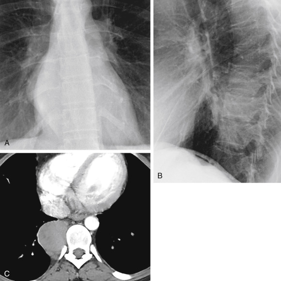 Posterior Mediastinal Mass Radiology Key 9951