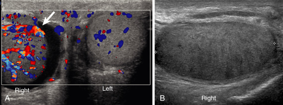 Nontraumatic Abdominal Emergencies | Radiology Key