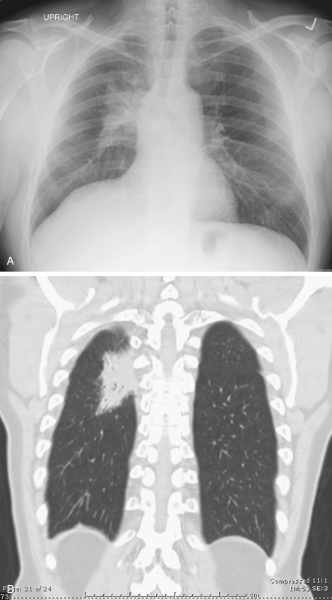 Atelectasis Radiology Key