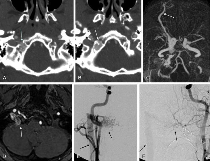 Imaging Of The Craniovertebral Junction | Radiology Key