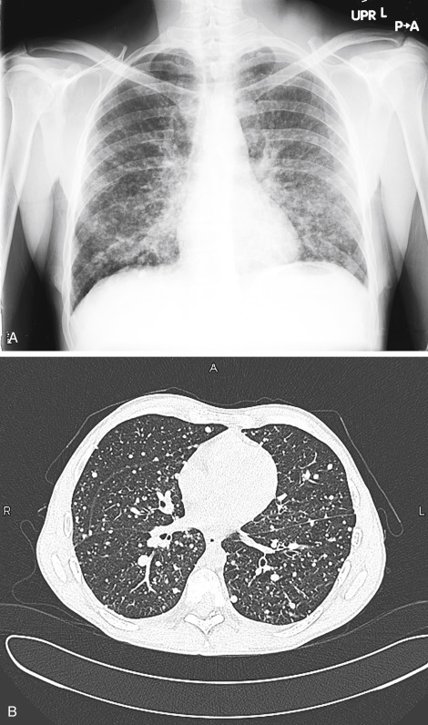 Diffuse Fine Nodular Opacities Radiology Key