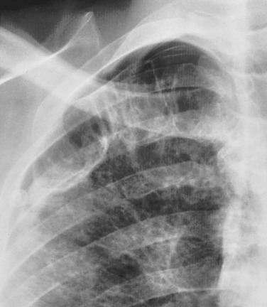 Intramedullary Lesions Multiple Neupsy Key