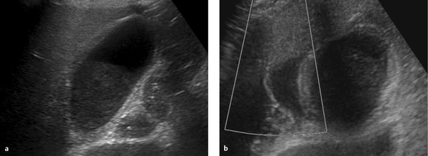 Gallbladder And Biliary Tract | Radiology Key