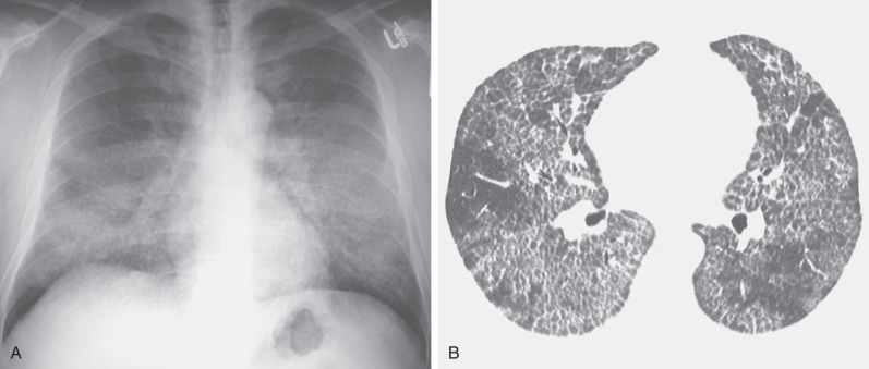 Interstitial Patterns | Radiology Key