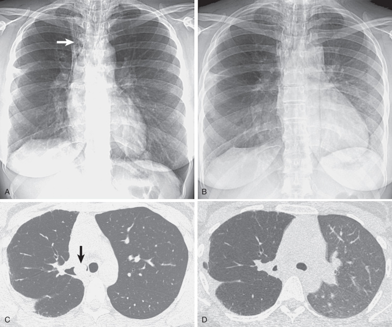 decreased-lung-density-radiology-key