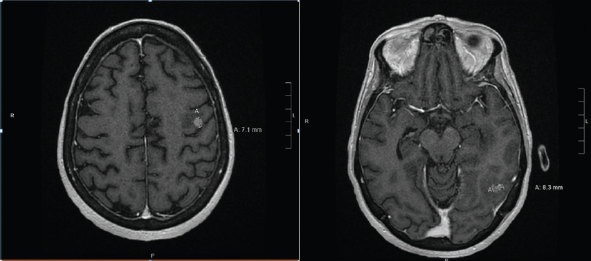 Brain Metastases Radiology Key
