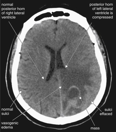 Imaging the Head and Brain | Radiology Key