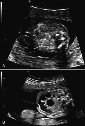 echogenic ultrasound