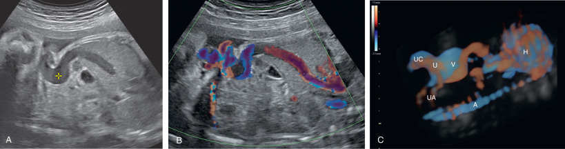 Abdominal Cysts | Radiology Key