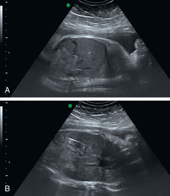 Hepatic Anomalies | Radiology Key