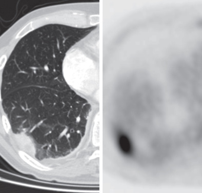 Cryptogenic Organizing Pneumonia/Secondary Organizing Pneumonia ...