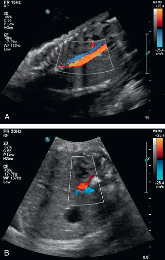 Fetal Spleen Radiology Key 1424