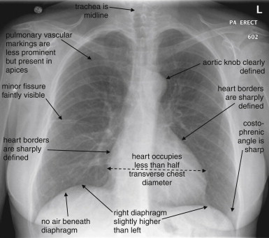 Imaging the Chest: The Chest Radiograph | Radiology Key