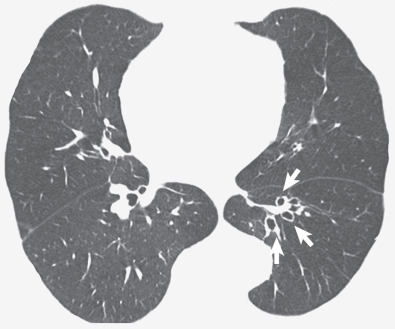 Chronic Pulmonary Thromboembolism | Radiology Key