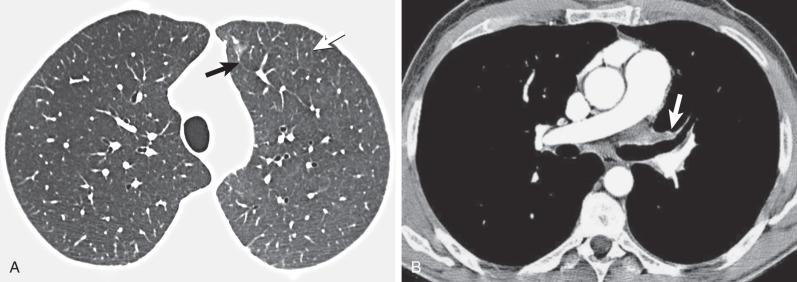 Hydrostatic Pulmonary Edema Radiology Key