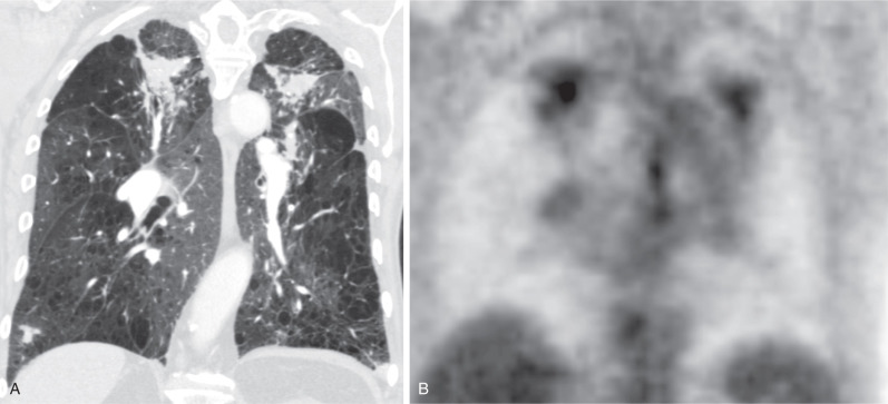 Silicosis And Coal Workers Pneumoconiosis Radiology Key 3468