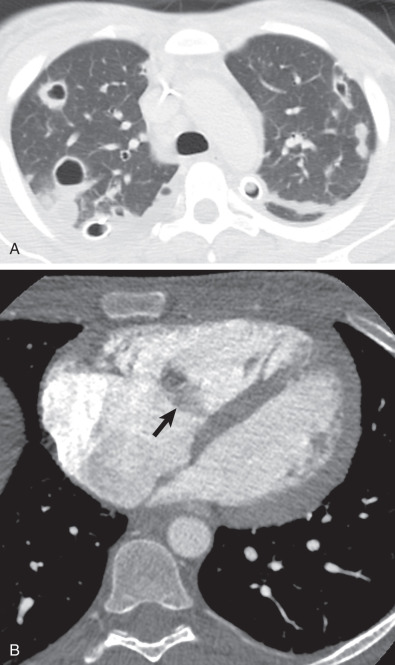 Drug Induced Lung Disease Radiology Key 9292