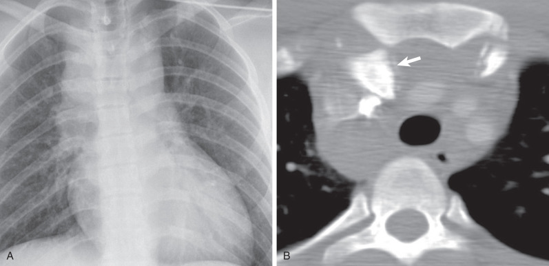 Blunt Thoracic Trauma | Radiology Key