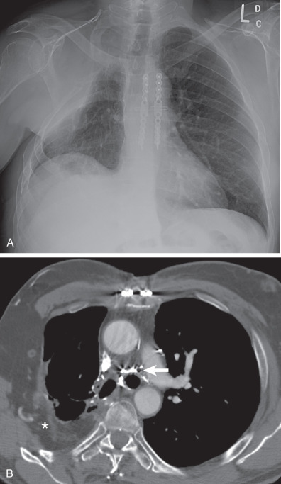 Pleural Effusion | Radiology Key