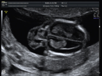 cystic hygroma ultrasound