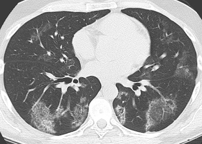 Noninfectious Lung and Stem Cell Transplantation Complications ...