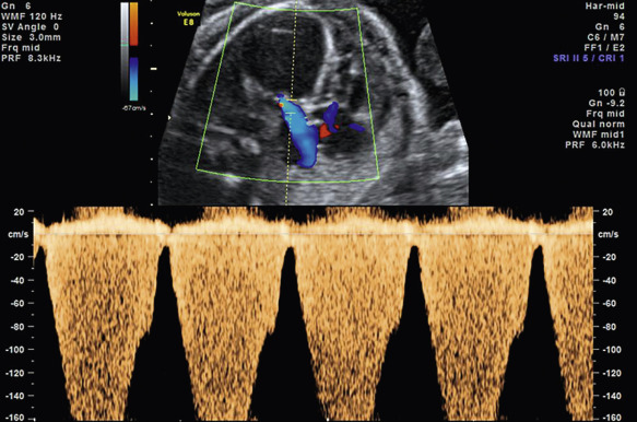 Aortic Stenosis And Aortic Atresia Radiology Key