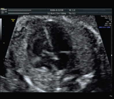 Interruption of the Aortic Arch | Radiology Key