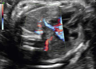 Atrial Isomerism | Radiology Key