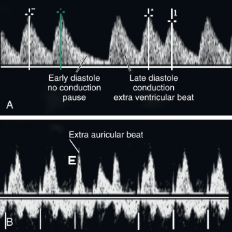 Arrhythmias | Radiology Key