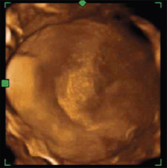 circummarginate placenta ultrasound