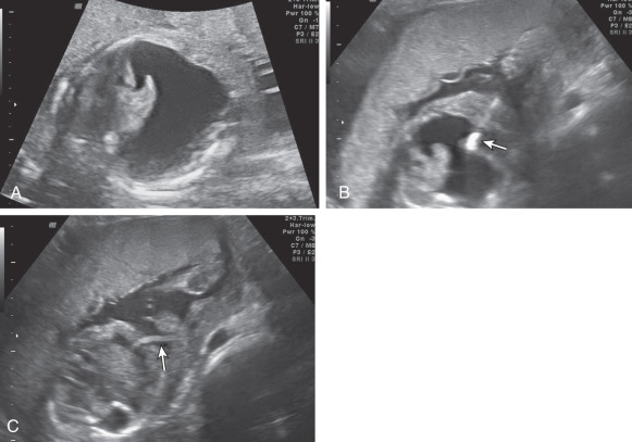 fetal-shunts-radiology-key