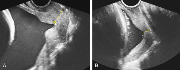 Cervical Length And Spontaneous Preterm Birth Radiology Key