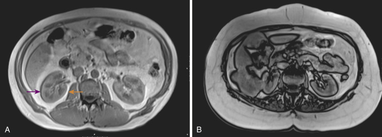 Imaging Principles In Magnetic Resonance Imaging | Radiology Key