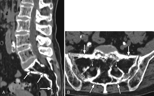 Aneurysmal Bone Cyst Radiology Key