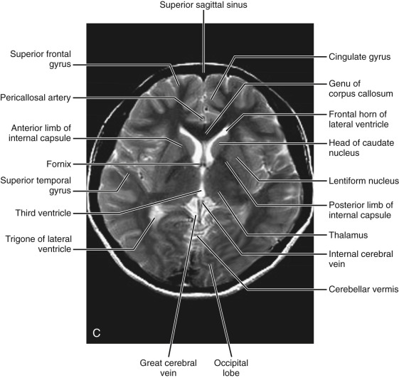 Brain Anatomy Axial
