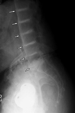 Ankylosing Spondylitis Radiology Key