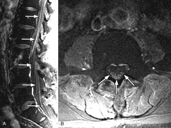 Arachnoiditis | Radiology Key