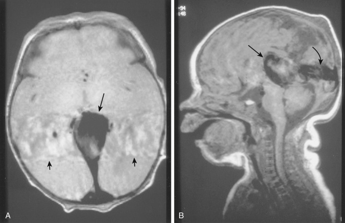 Cerebral Aneurysms And Cerebrovascular Malformations Radiology Key