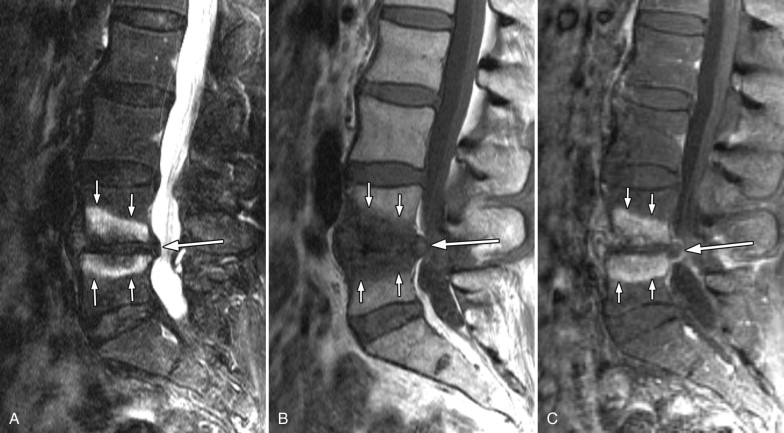 A gerinc lumbosacrális artrózisának kezelése