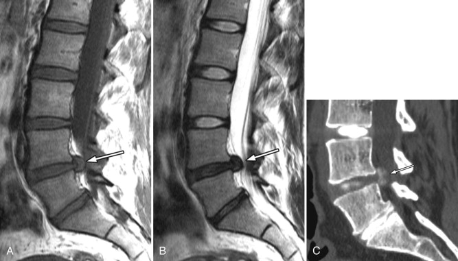 Disc Herniation—Lumbar | Radiology Key