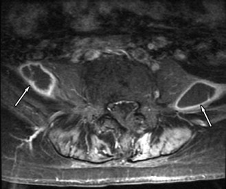 Vertebral Osteophytosis (Spondylosis Deformans) | Radiology Key