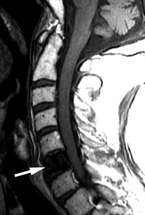 Paget Disease 