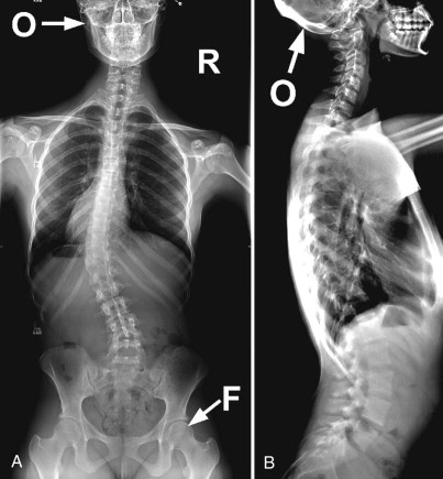 lumbar scoliosis x ray