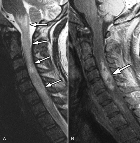 Spinal Cord Infarction | Radiology Key