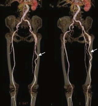 Vascular Anatomy And Variants | Radiology Key