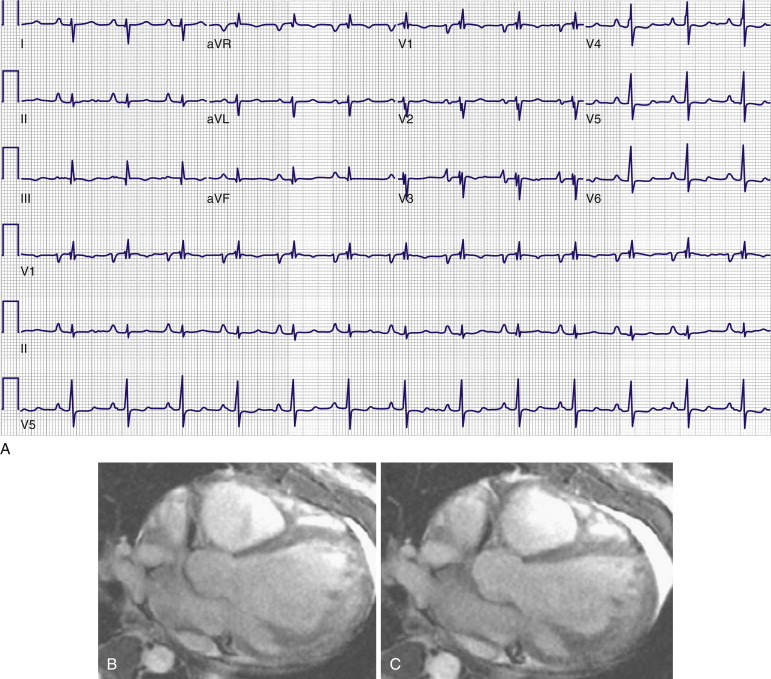 Role Of Magnetic Resonance Imaging In Cardiomyopathies Radiology Key