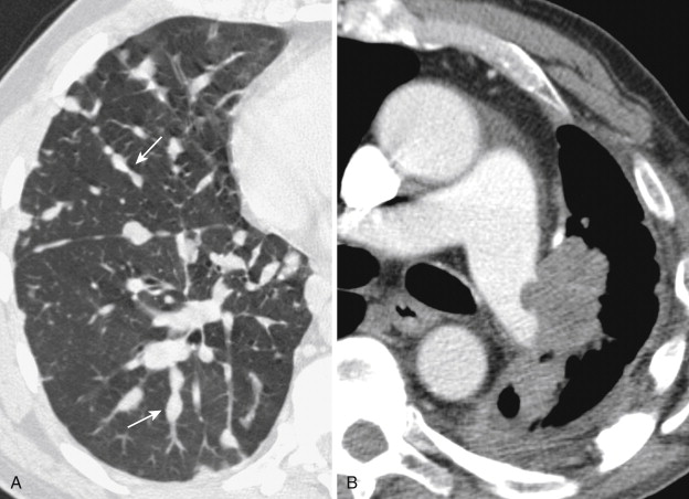 pulmonary-arteries-radiology-key