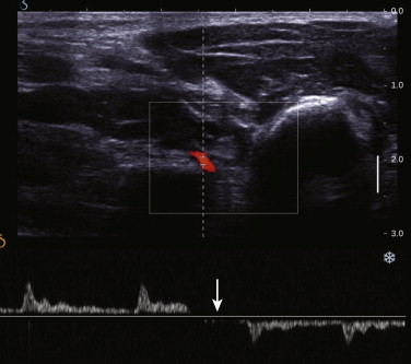 Upper Extremity Arteries Radiology Key